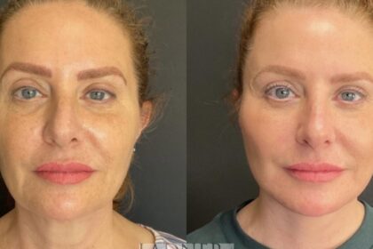Fat Grafting An Ideal Procedure for a More Shapely Appearance
