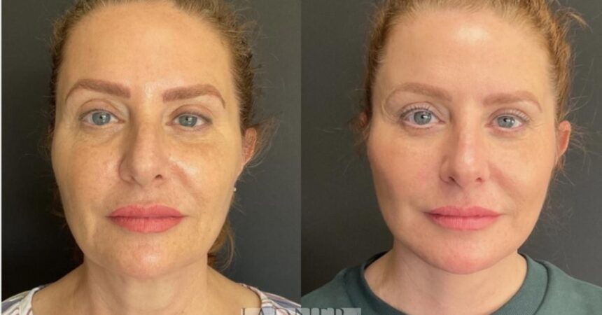 Fat Grafting An Ideal Procedure for a More Shapely Appearance